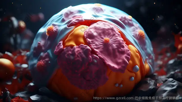 巴中细胞免疫干预治疗肺鳞癌